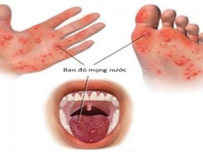 Bệnh tay – chân – miệng